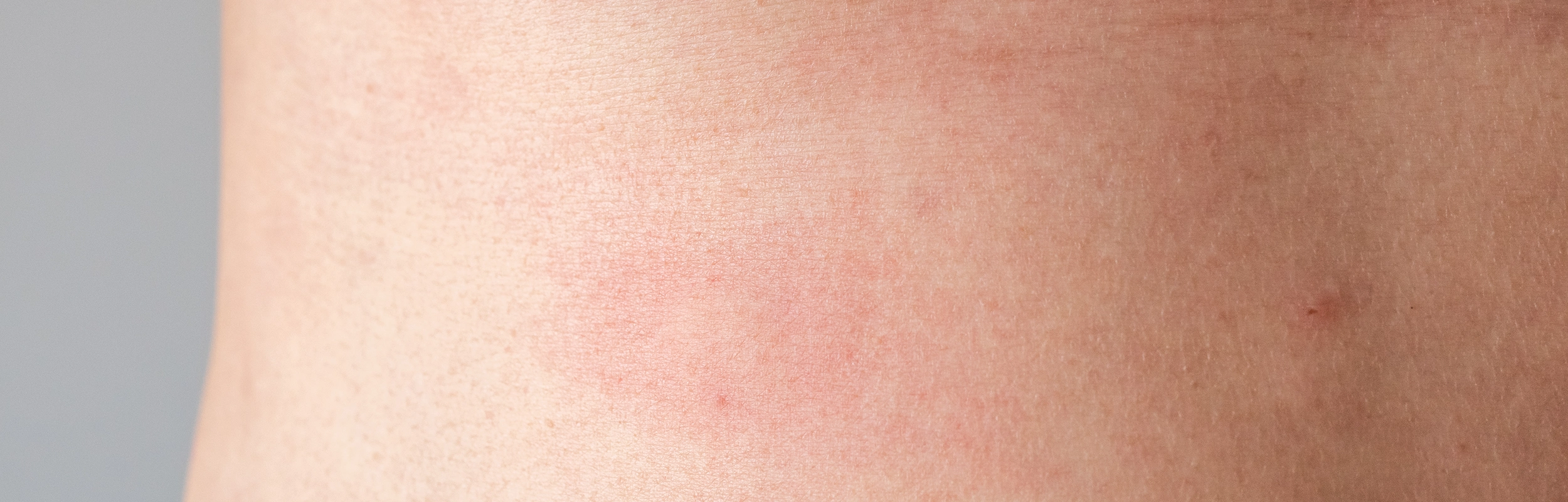 By Derm - Dermatitis